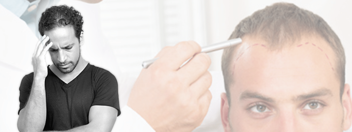 Hårtransplantasjon Effekt